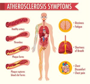 Atherosclerosis Symptoms
